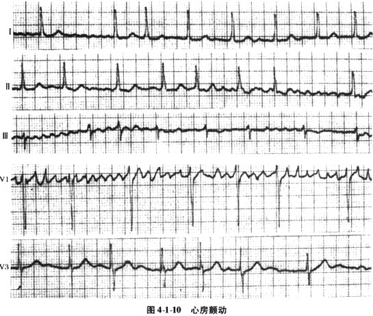 [问答题,简答题] 心房颤动的心电图特点.