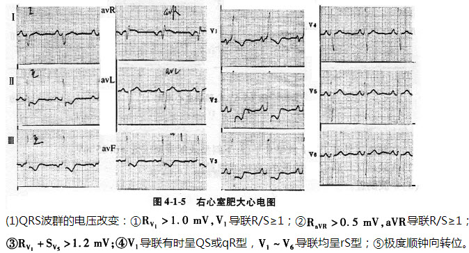 2.右心室肥大:右心室肥大的心电图特点(图4-1-5)