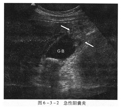 [问答题,简答题 急性胆囊炎.