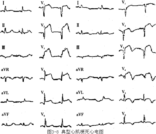[问答题,简答题] 典型急性心肌梗死心电图特征