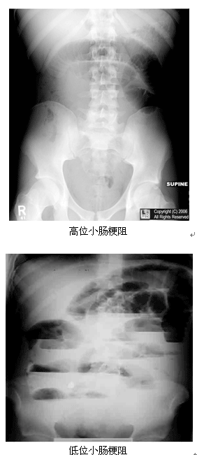 梗阻部位(低位小肠梗阻与高位小肠梗阻)的鉴别诊断?