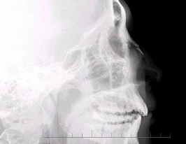 c.鼻骨骨折处可见小骨片影向下方分离 d . d.考虑为鼻骨线性骨折 e .