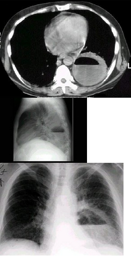 左下肺肺脓肿 b . b.左下肺癌并空洞形成 c . c.左侧胸腔积脓 d . d.