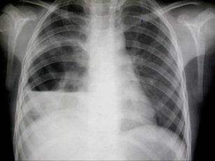 右侧液气胸 d . d.右侧膈膨升 e . e.右肺脓肿