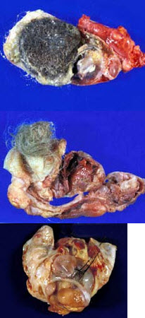 图中为卵巢成熟畸胎瘤,可发生于任何年龄,以()