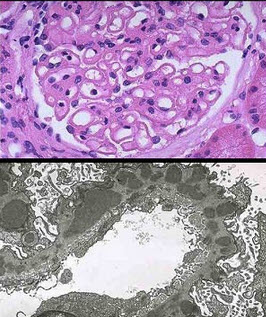 光镜和电镜肾脏病理表现如下(图-1:pas基底膜增厚,系