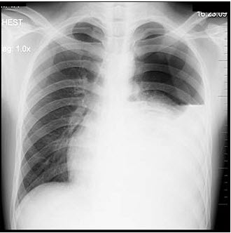 左侧胸膜肥厚 d . 左侧液气胸 e . 左侧肺不张