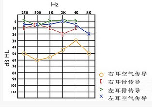 耳硬化骨导听力曲线呈v形下降常在哪个频率,可参照图回答()