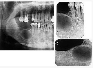口腔颌面影像题库  问题: [单选]  a . 根尖囊肿 b . 牙龈瘤 c .