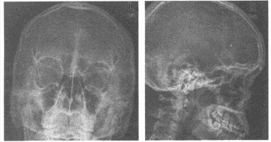 眶内壁骨折 c . 右眶内异物 d . 上颌骨骨折 e . 正常眼眶