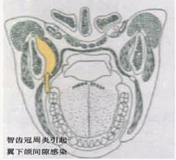 口腔颌面外科学题库  问题: [单选]  a . 咬肌间隙感染 b .