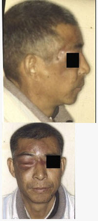 患者男,28岁,左面肿痛3天,查左眶下区红肿,压痛明显