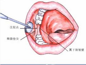 下牙槽阻滞麻醉时注射针往后外方与中线所成角度为a15b30c45d60e75