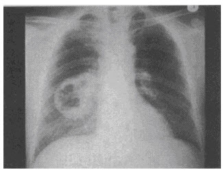患者男,54岁,咳嗽,伴胸痛2周,午后有低热,胸片如图,最可能的诊断是()