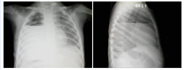 液气胸 e . 肺脓肿