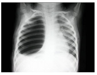 x线题库 问题: [单选]  a . 气胸 b . 胸腔积液 c . 肺大泡 d .
