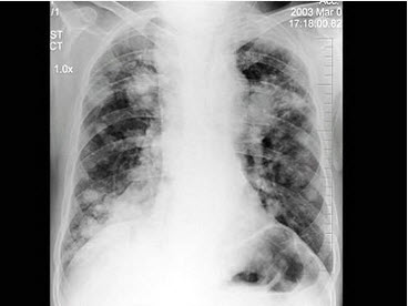 胸部题库  问题: [单选]  a . 血行播散型肺结核 b . 肺转移瘤 c .
