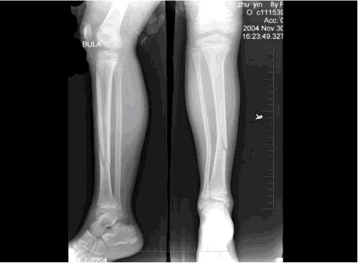 8岁女性患者,因外伤后致右胫骨骨折,x线如图,下列描述正确的是()