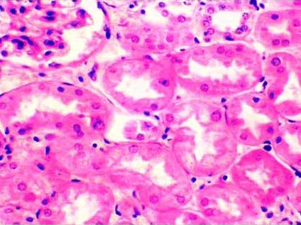 肾小管上皮细胞空泡变性是什么病