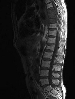脊髓半切综合征 c . 平面以下完全性肢体瘫痪 d .