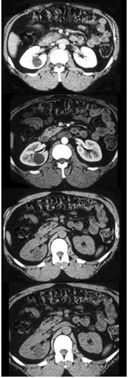 ct征象提出肾囊性病变四级分类法,下列图像中的肾囊肿属于哪一类()