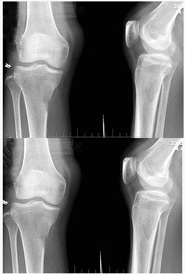 男,59岁,右小腿近端疼痛1年,活动障碍半年,结合图像,最可能的诊断是()