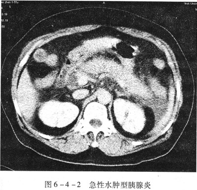 胰腺炎ct表现图图片