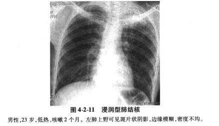 浸润性肺结核图片图片