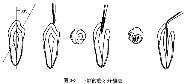 [問答題,簡答題] 簡述開髓術(離體前磨牙或磨牙).