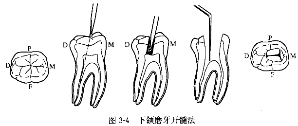 [问答题,简答题] 简述开髓术(离体前磨牙或磨牙).