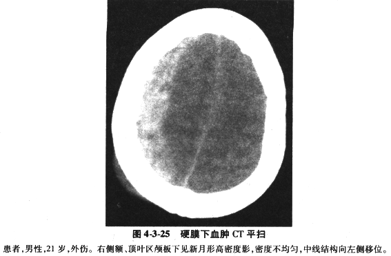 硬膜下血肿ct图图片