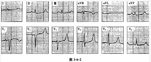 心電學技術習題集題庫問題: [單選] a . 低鉀血癥 b . 高鉀血癥 c .