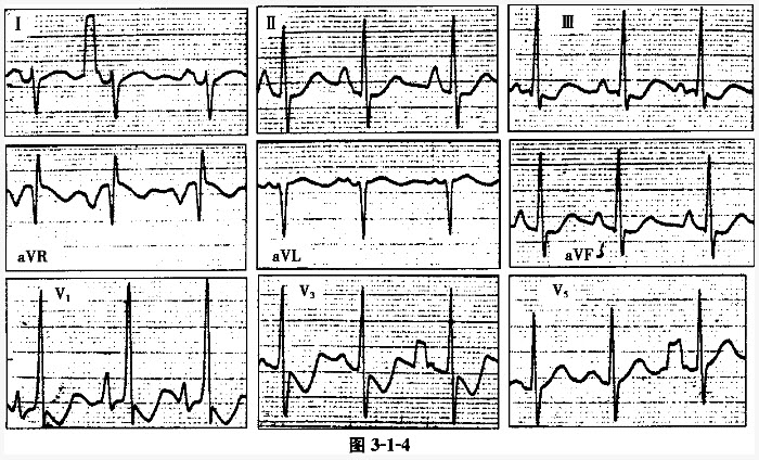 风湿性心脏病心电图图片