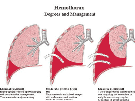 血胸的诊断要点,临床表现是什么?