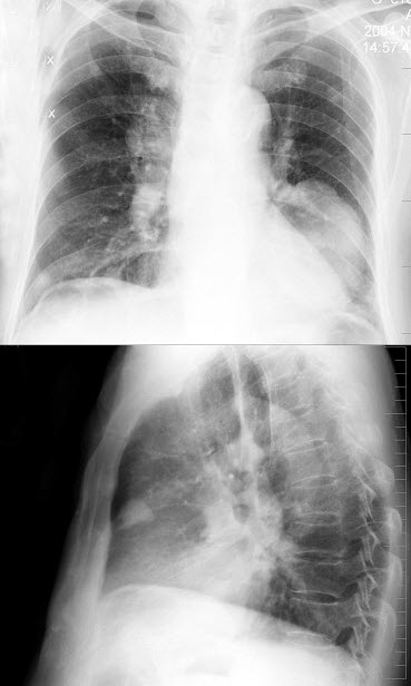 胸膜炎的胸片图图片