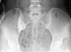 女,50岁,因右侧骶髂关节疼痛半年伴左下腹部疼痛,血尿1天,x线检查如图