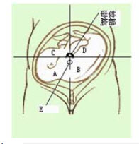 胎心音听诊位置图片图片