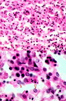 炎症病变中,主要有中性粒细胞和巨噬细胞两种吞噬细胞,其中巨噬细胞