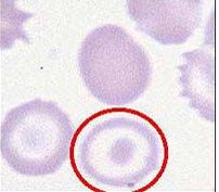 d镰形红细胞e  e泪滴形红细胞