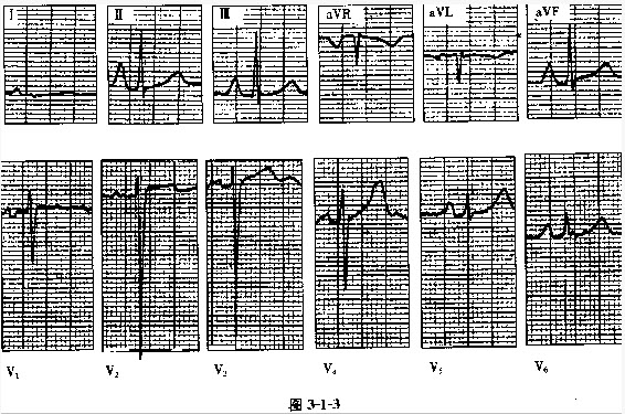 风湿性心脏病心电图图片