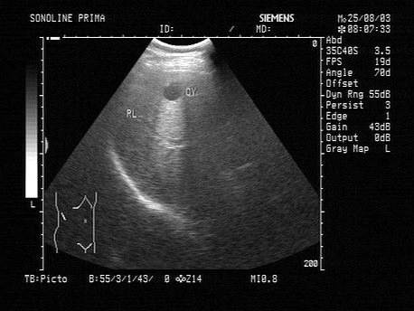肝囊肿的声像图表现以下哪一项是错误的