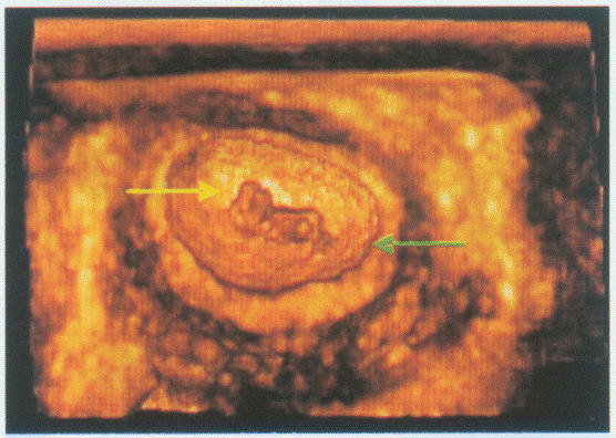 临床资料:女,25岁;孕9周。超声综合描述:图1:宫