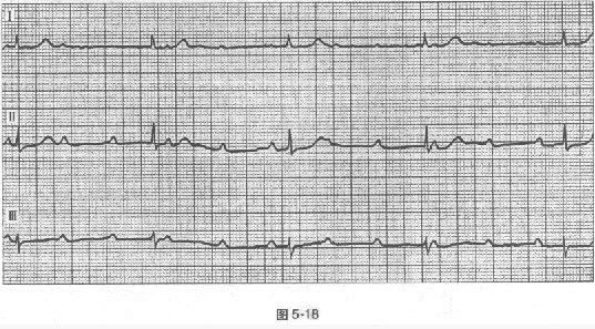 二度Ⅱ型竇房阻滯 d . 三度房室傳導阻滯 e .