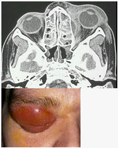 眼眶蜂窝织炎(如图)的严重并发症有()
