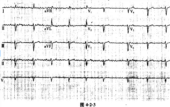 常見心電圖的分析與鑑別題庫