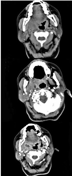 女,52岁,咽喉部疼痛半个月,伴低热,ct如图所示,可能诊断为().