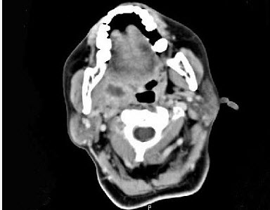 喉咽部ct图片