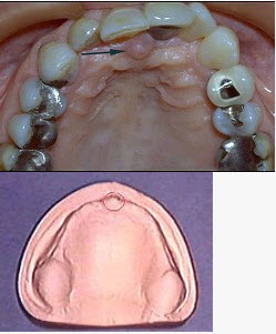 切牙乳突的位置图片