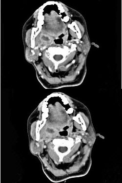 喉咽部ct图片