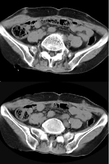 腹部肌肉瘤症状图片图片